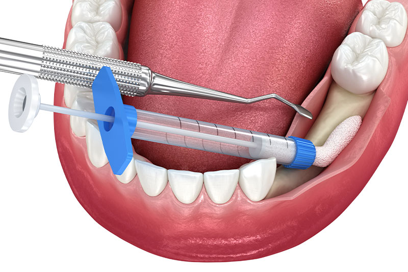 Bone Grafting in Baltimore