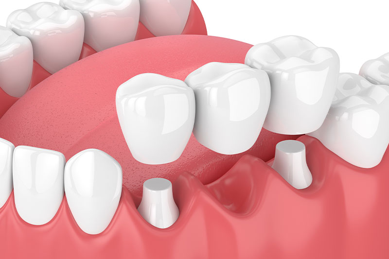 Quality Dental Treatments in Baltimore