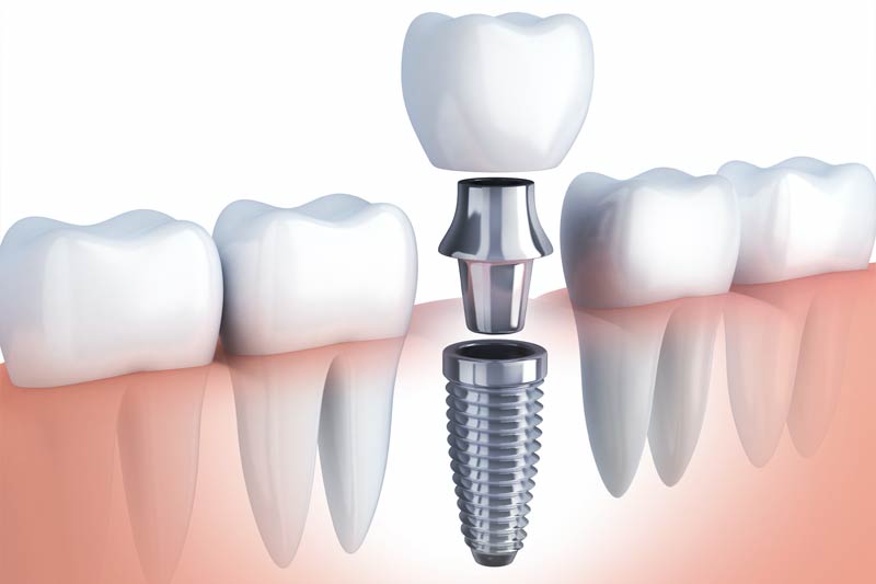 Implants Dentist in Baltimore