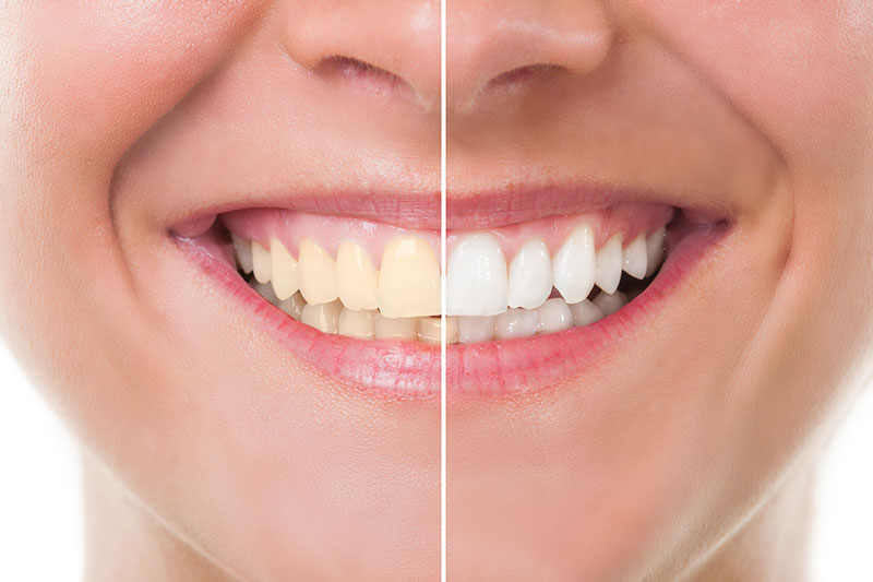 Teeth Whitening in Baltimore